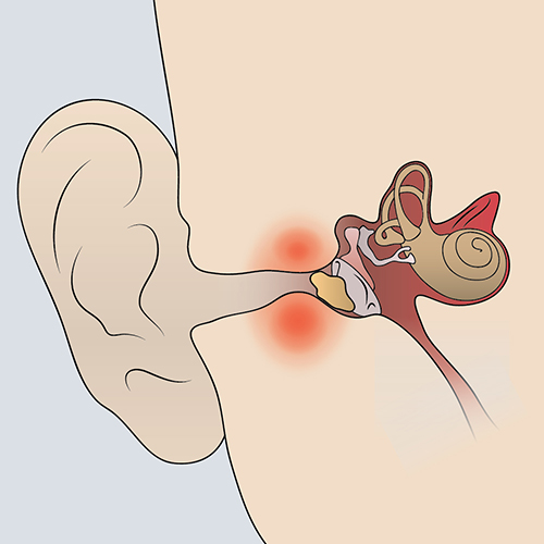 Diagram showing the anatomy of the ear, highlighting areas affected by conductive hearing loss.