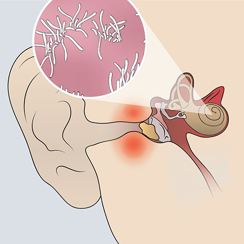 Illustration of an ear with an inset showing bacteria; highlights mixed hearing loss and potential infection site.