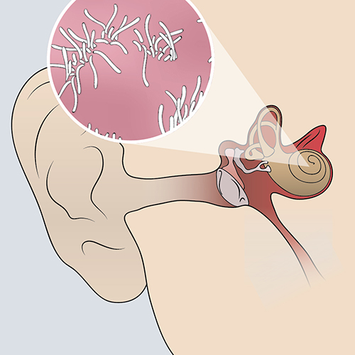 Diagram illustrating the human ear with a focus on hair cells, related to sensorineural hearing loss.